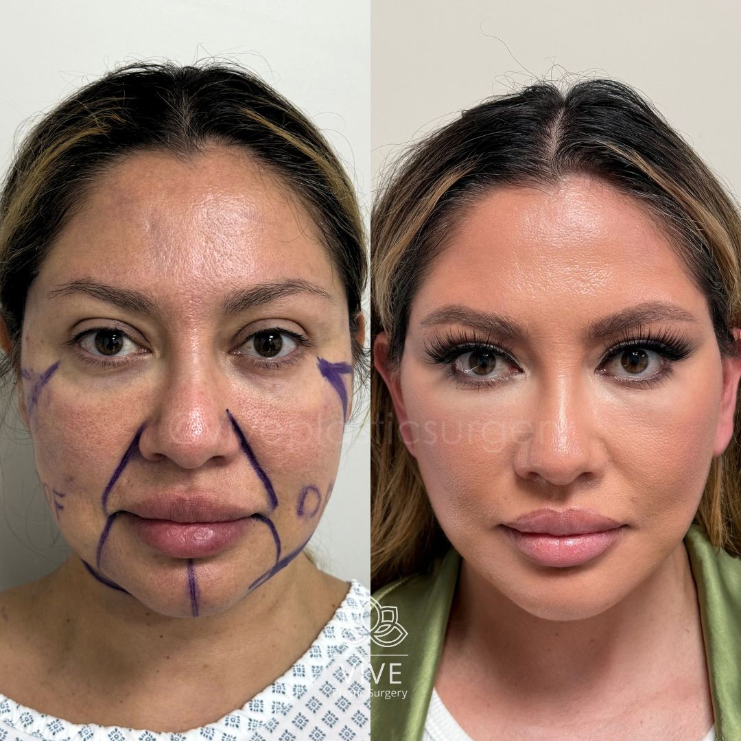 Antes y después de cirugía estética facial: comparativa de resultados con marcas prequirúrgicas y transformación final