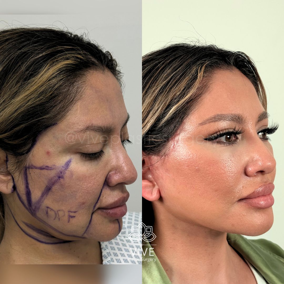 Antes y después de cirugía facial: resultados de rejuvenecimiento y redefinición de contornos en perfil