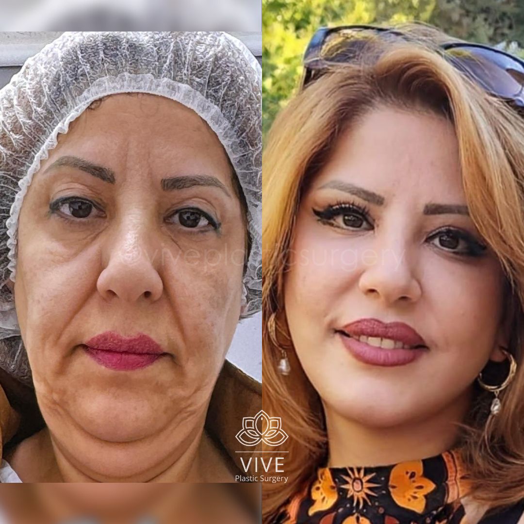 Resultados de cirugía facial antes y después - Rejuvenecimiento: Deep Plane, neck lift y blefaroplastia