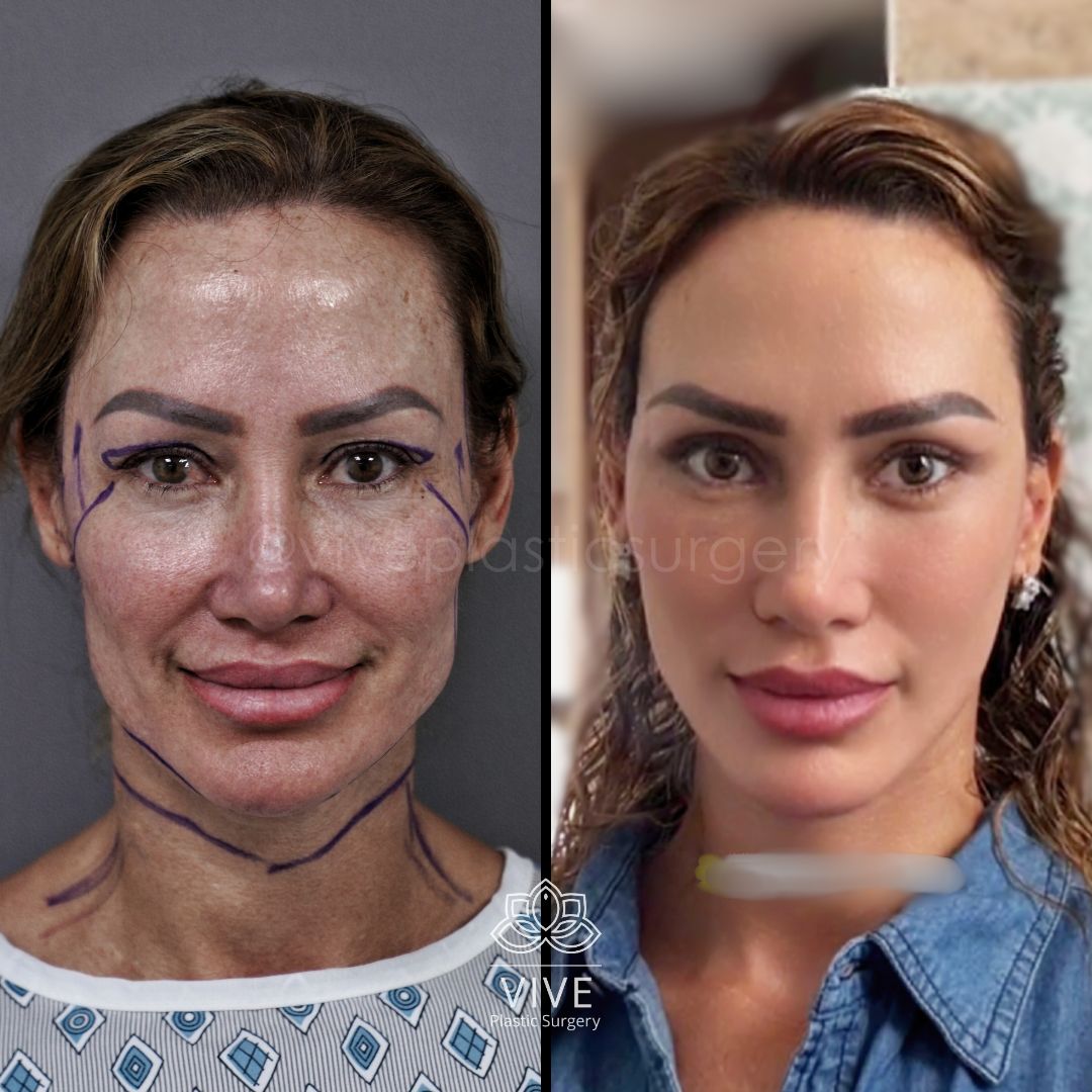 Antes y después de cirugía facial rejuvenecedora - Resultados de lifting con Deep Plane