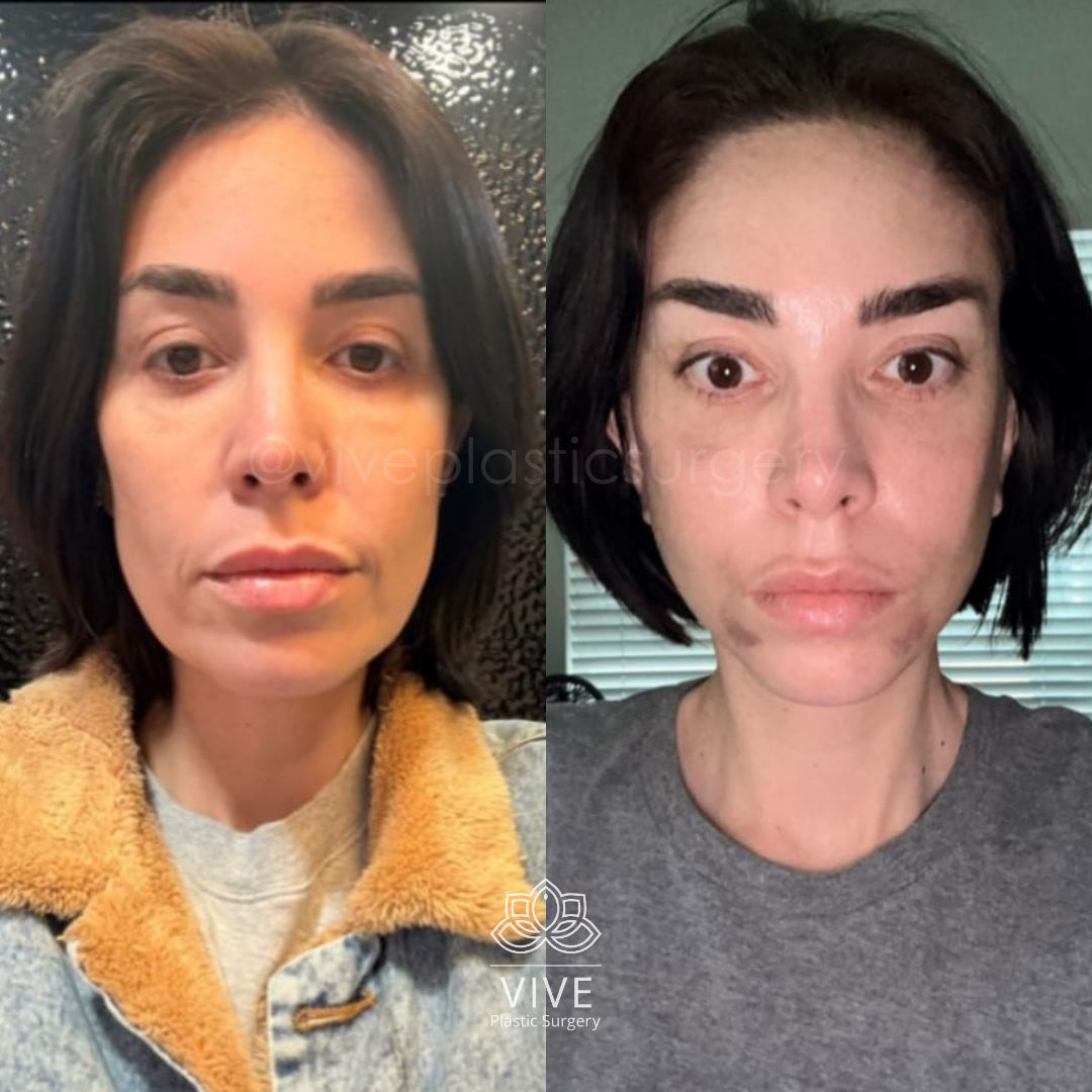 Resultados antes y después de cirugía plástica facial - Endoscópico con Deep Plane