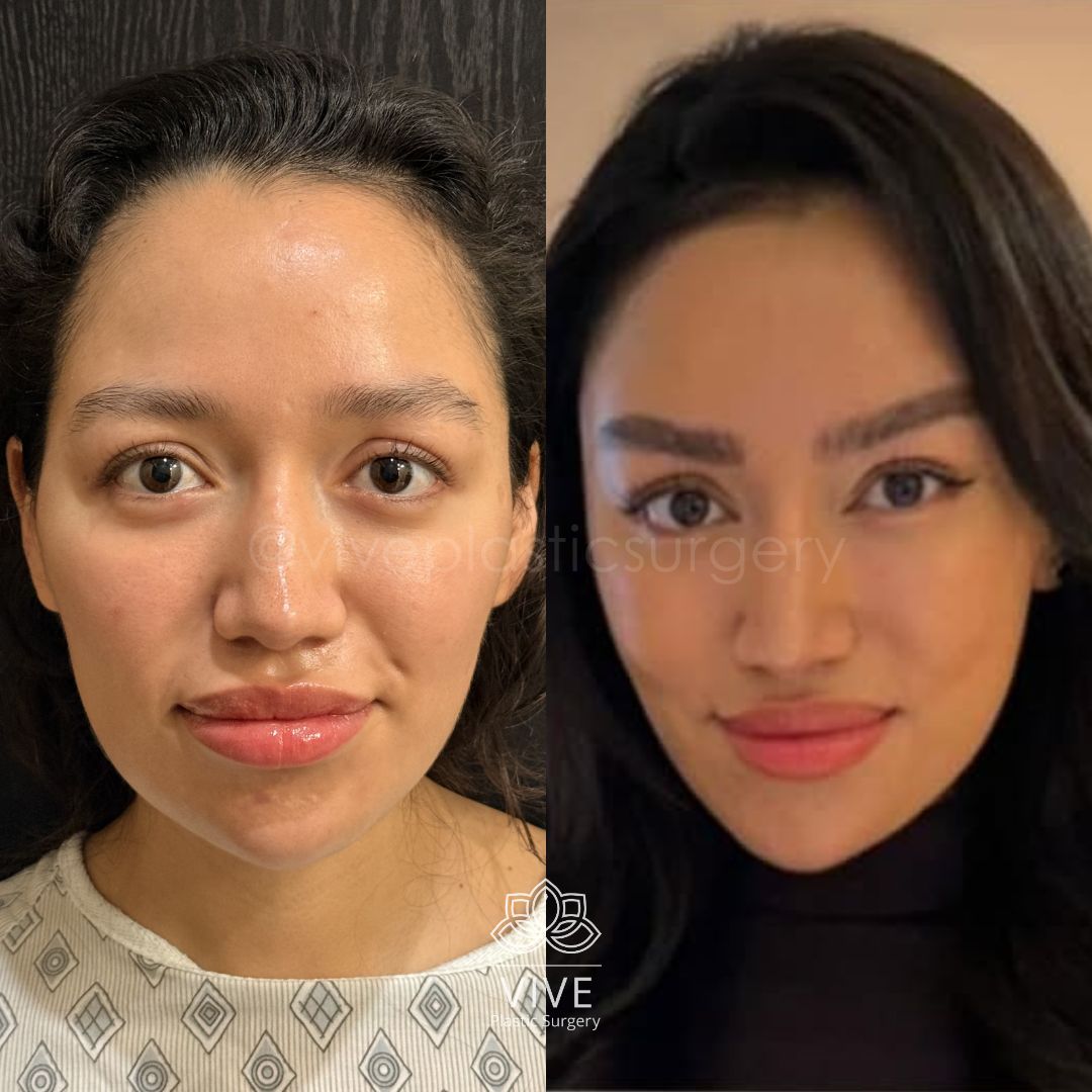Antes y después de cirugía estética facial: resultados de tratamiento de armonización y contorno facial