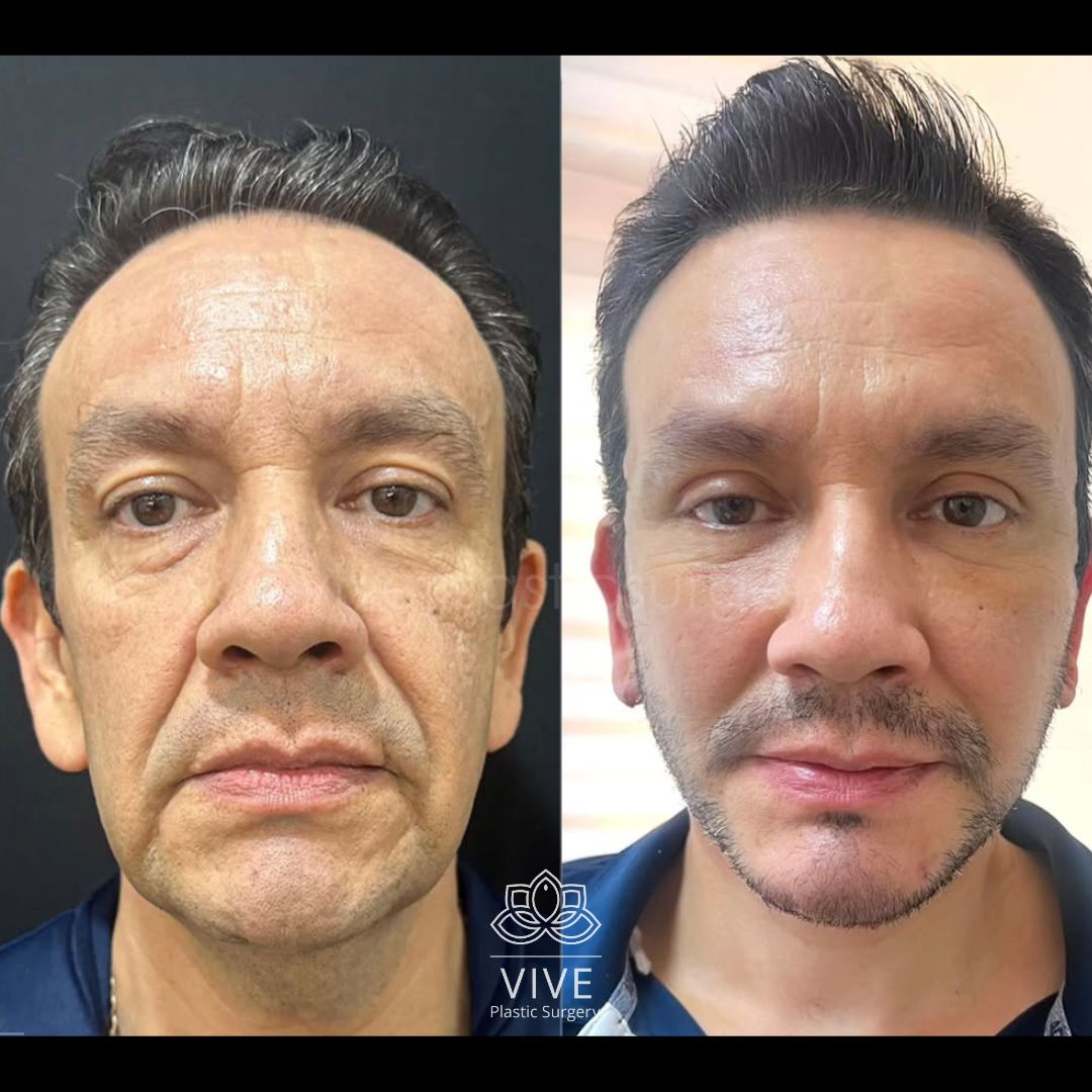 Resultados de rejuvenecimiento facial masculino antes y después - Vive Plastic Surgery
