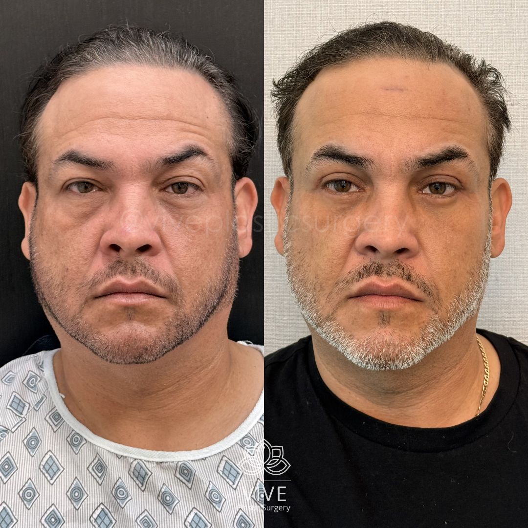 Antes y después de cirugía estética facial masculina: resultados de rejuvenecimiento y definición del rostro
