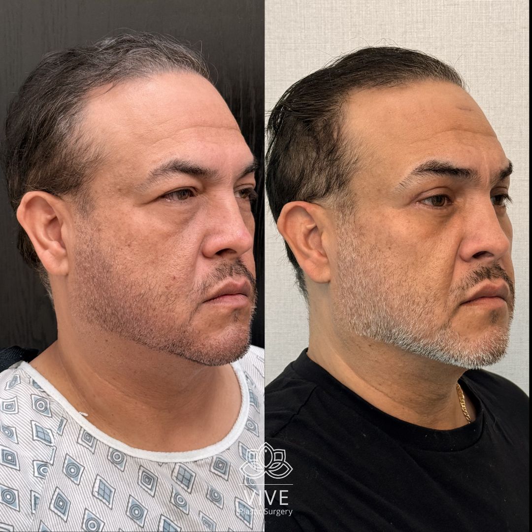 Antes y después de cirugía facial masculina: resultados de lifting facial y definición del contorno mandibular